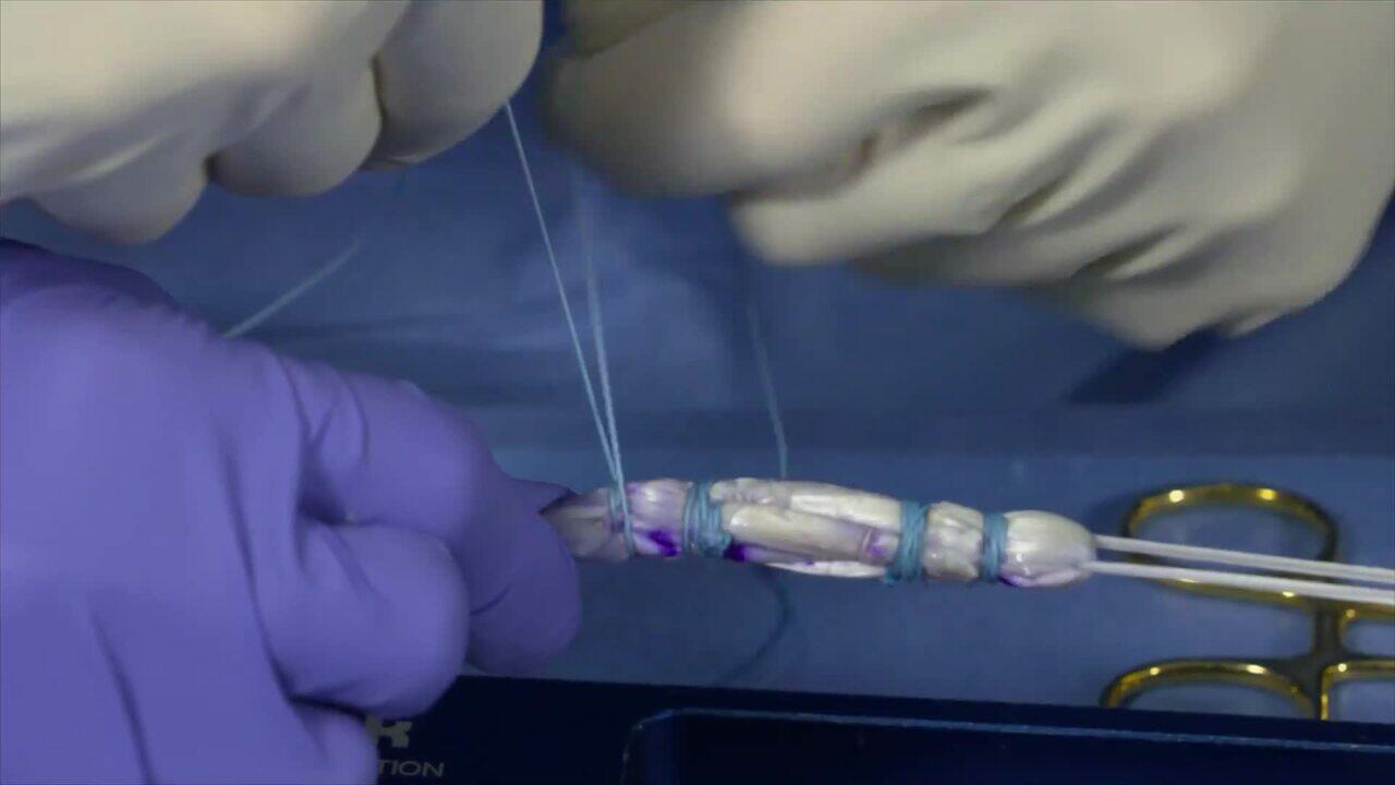 RIGIDLOOP™ Adjustable Cortical Fixation System | Products | DePuy
